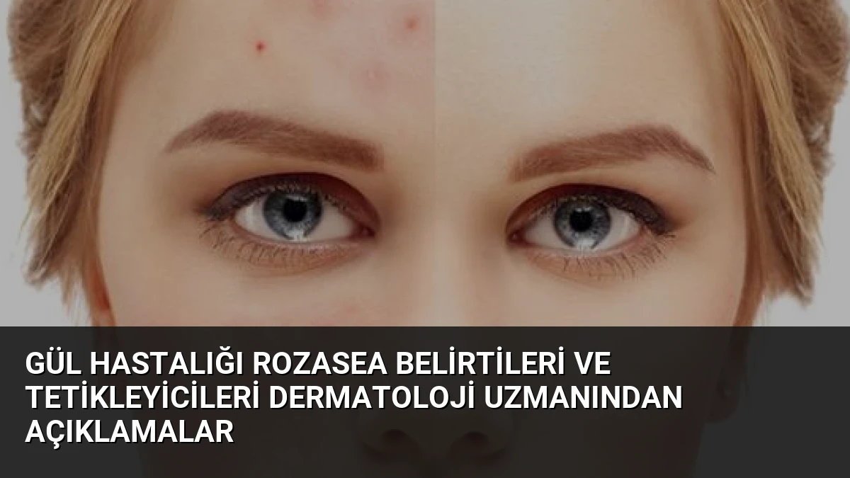 Gül Hastalığı Rozasea Belirtileri ve Tetikleyicileri Dermatoloji Uzmanından Açıklamalar