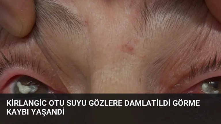 Kirlangic Otu Suyu Gözlere Damlatildi Görme Kaybı Yaşandi