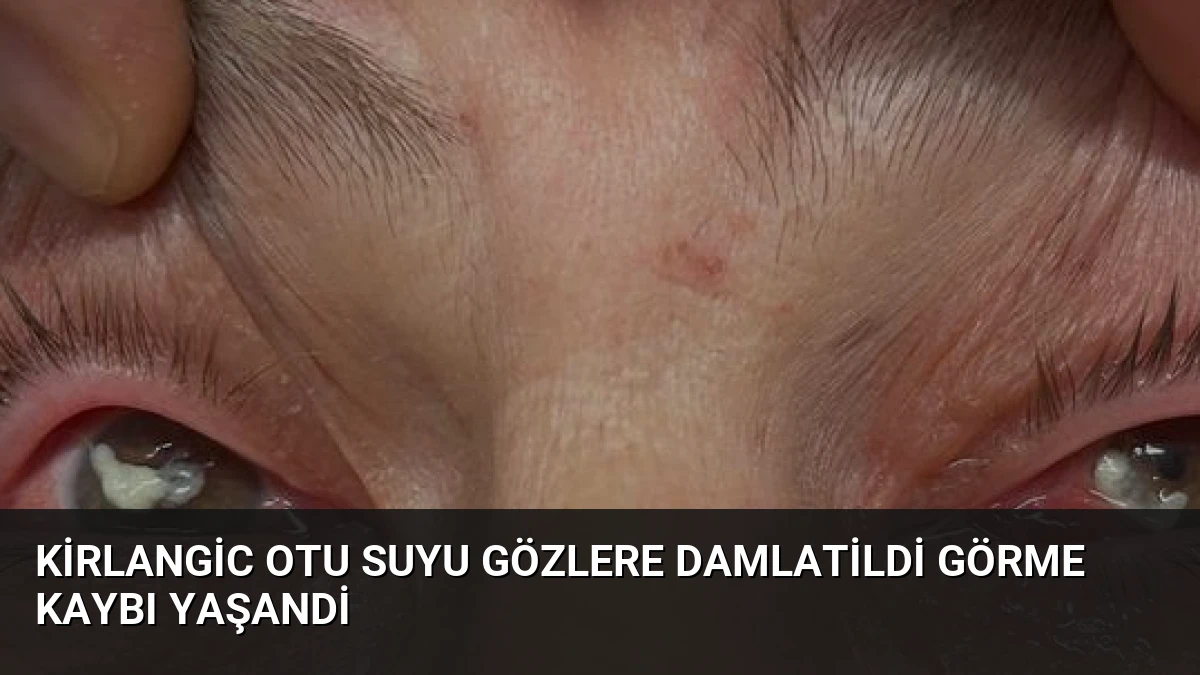Kirlangic Otu Suyu Gözlere Damlatildi Görme Kaybı Yaşandi