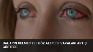 Baharın Gelmesiyle Göz Alerjisi Vakaları Artış Gösterdi
