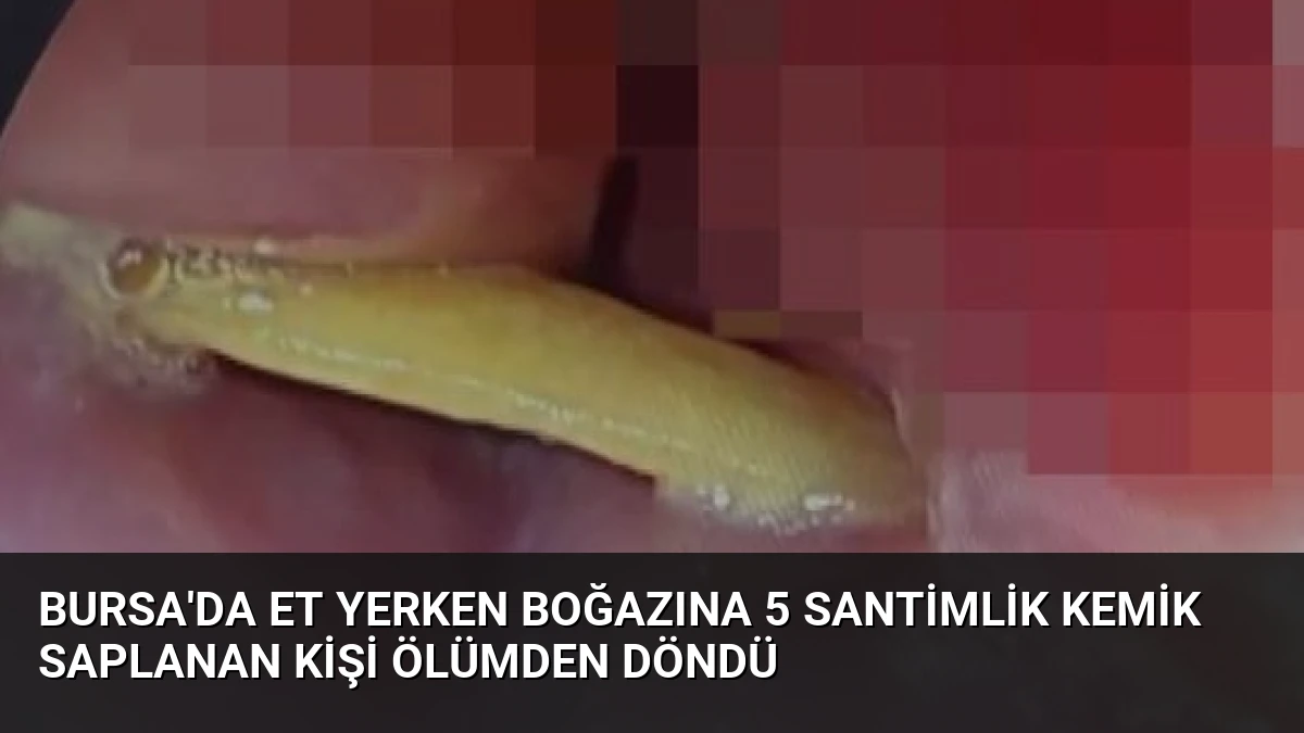 Bursa’da Et Yerken Boğazına 5 Santimlik Kemik Saplanan Kişi Ölümden Döndü